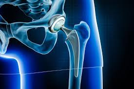 Joint Replacement